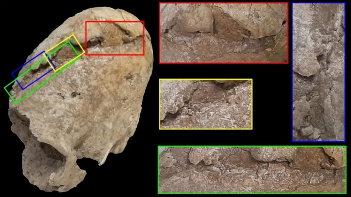 Crânio cônico de 6 mil anos é achado com ferimento misterioso